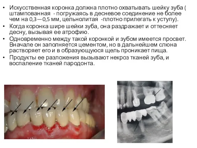 Искусственная коронка должна плотно охватывать шейку зуба ( штампованная - погружаясь в десневое