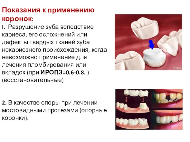 Показания к применению коронок: I. Разрушение зуба вследствие кариеса, его осложнений или дефекты
