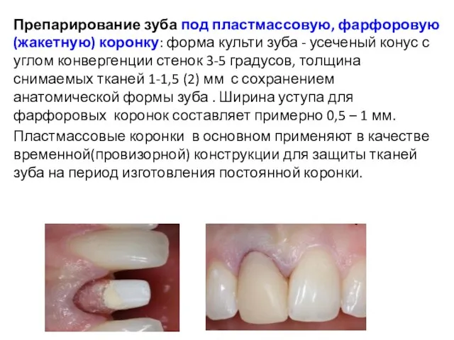 Препарирование зуба под пластмассовую, фарфоровую (жакетную) коронку: форма культи зуба - усеченый конус
