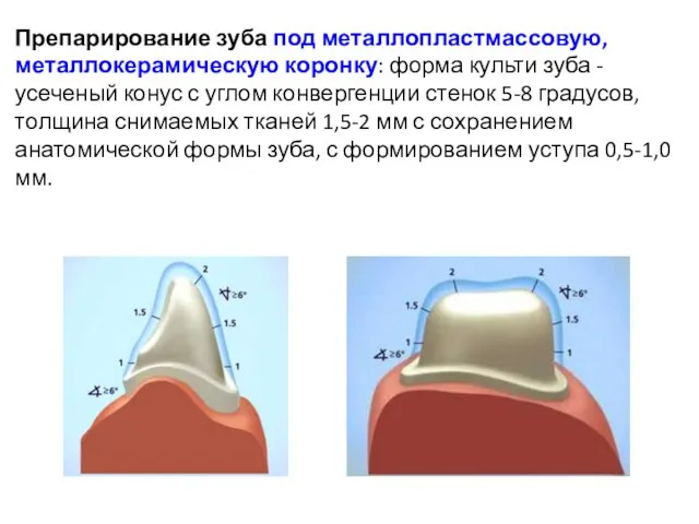 Препарирование зуба под металлопластмассовую, металлокерамическую коронку: форма культи зуба - усеченый конус с