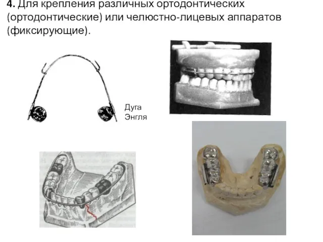 4. Для крепления различных ортодонтических (ортодонтические) или челюстно-лицевых аппаратов (фиксирующие). Дуга Энгля