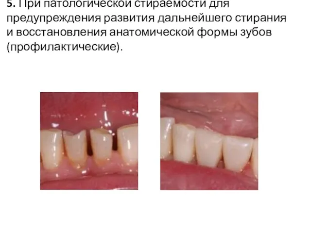 5. При патологической стираемости для предупреждения развития дальнейшего стирания и восстановления анатомической формы зубов (профилактические).