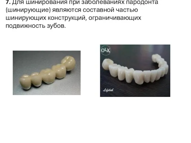 7. Для шинирования при заболеваниях пародонта (шинирующие) являются составной частью шинирующих конструкций, ограничивающих подвижность зубов.
