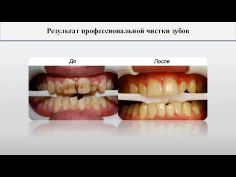 Результат профессиональной чистки зубов