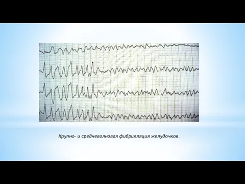 Крупно- и средневолновая фибрилляция желудочков.