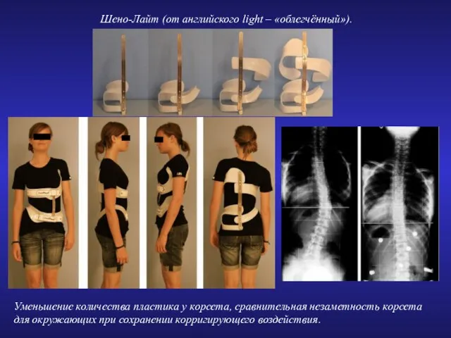 Уменьшение количества пластика у корсета, сравнительная незаметность корсета для окружающих