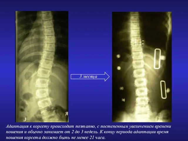 3 месяца Адаптация к корсету происходит поэтапно, с постепенным увеличением