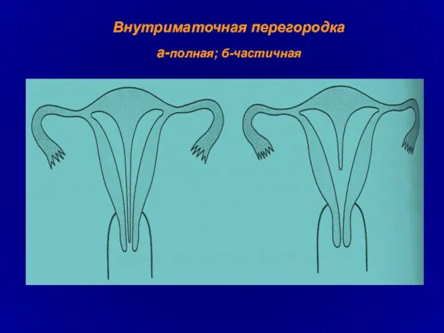 Внутриматочная перегородка а-полная; б-частичная