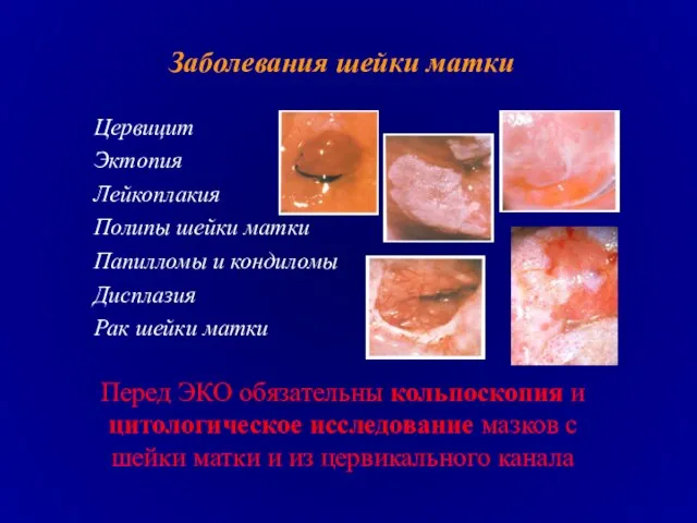 Заболевания шейки матки Цервицит Эктопия Лейкоплакия Полипы шейки матки Папилломы