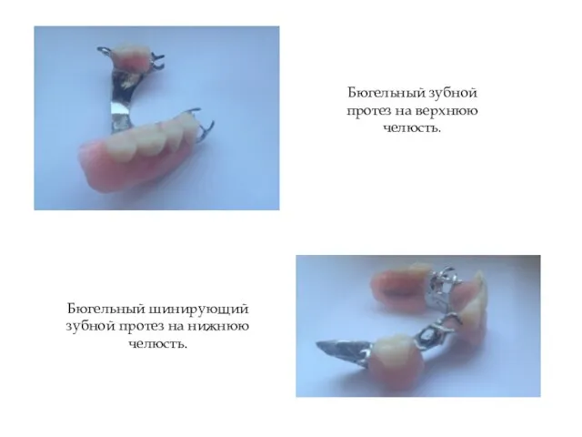 Бюгельный зубной протез на верхнюю челюсть. Бюгельный шинирующий зубной протез на нижнюю челюсть.