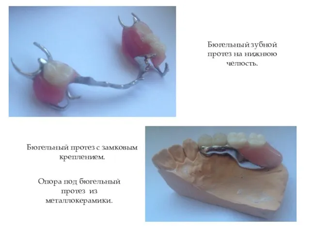 Бюгельный зубной протез на нижнюю челюсть. Бюгельный протез с замковым