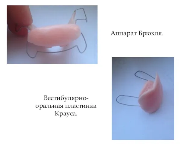 Аппарат Брюкля. Вестибулярно-оральная пластинка Крауса.