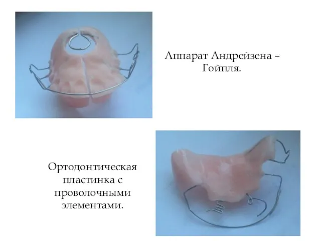 Аппарат Андрейзена – Гойпля. Ортодонтическая пластинка с проволочными элементами.