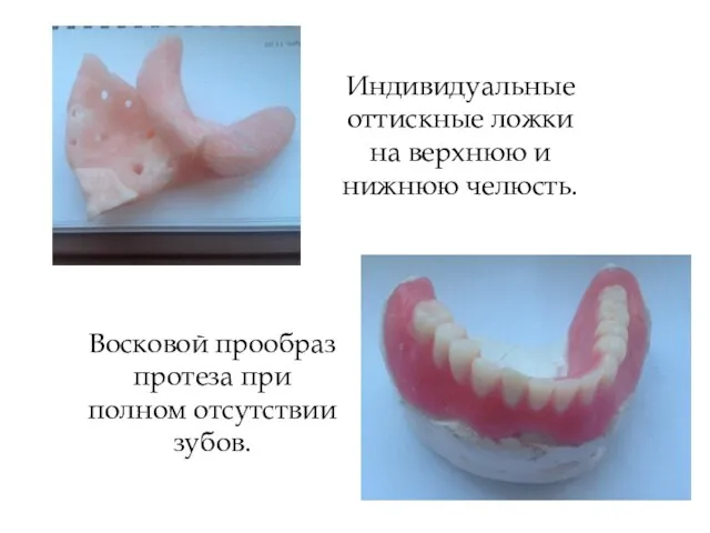 Индивидуальные оттискные ложки на верхнюю и нижнюю челюсть. Восковой прообраз протеза при полном отсутствии зубов.