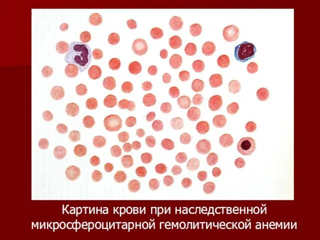 Картина крови при наследственной микросфероцитарной гемолитической анемии