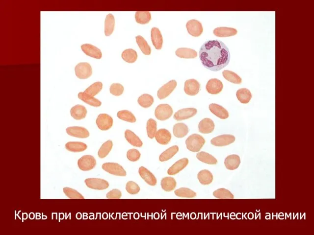 Кровь при овалоклеточной гемолитической анемии