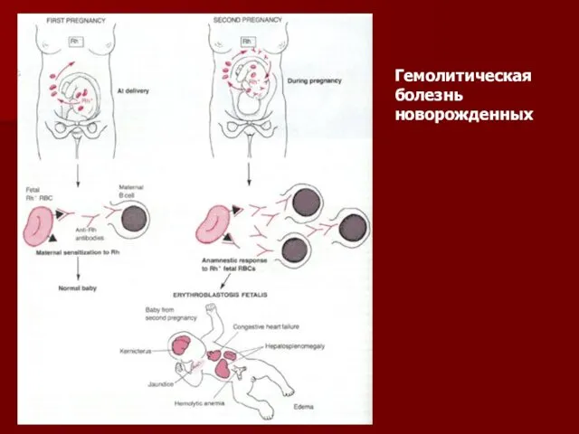 Гемолитическая болезнь новорожденных