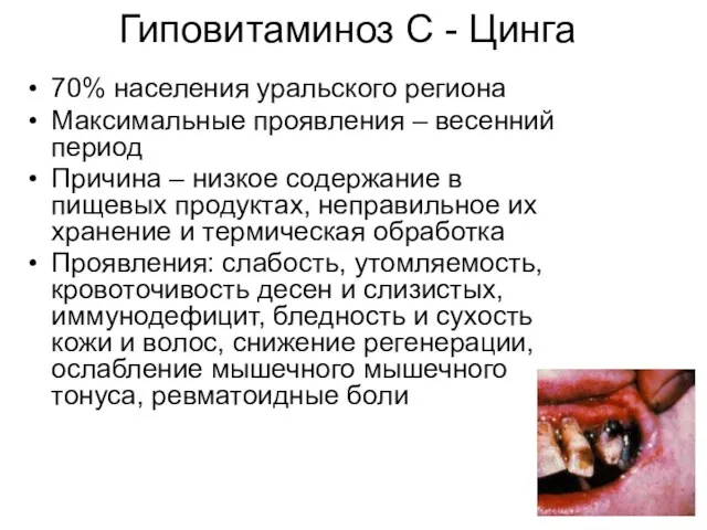 Гиповитаминоз С - Цинга 70% населения уральского региона Максимальные проявления