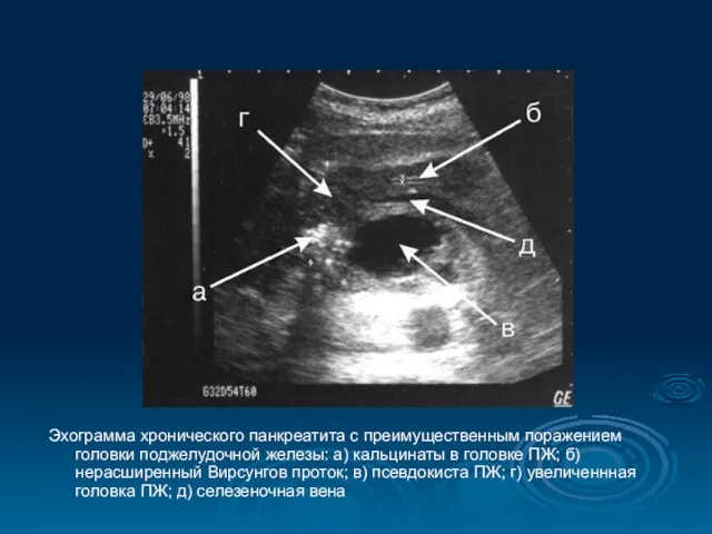 Эхограмма хронического панкреатита с преимущественным поражением головки поджелудочной железы: а)