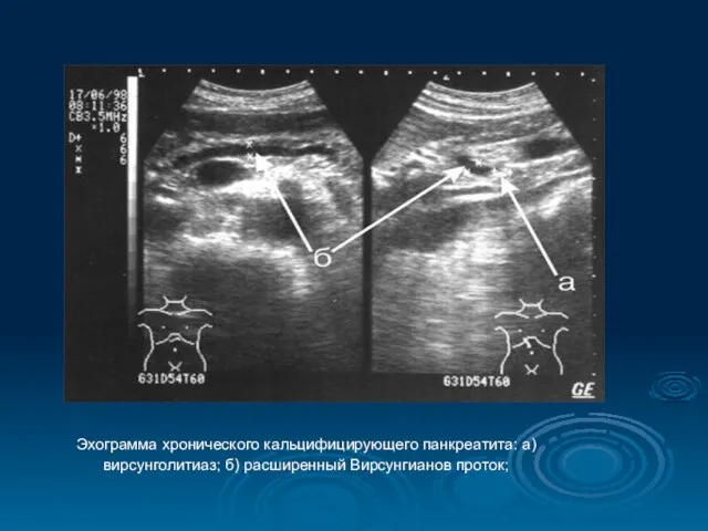 Эхограмма хронического кальцифицирующего панкреатита: а) вирсунголитиаз; б) расширенный Вирсунгианов проток;