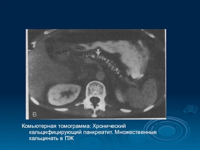 Комьютерная томограмма: Хронический кальцифицирующий панкреатит. Множественные кальцинать в ПЖ