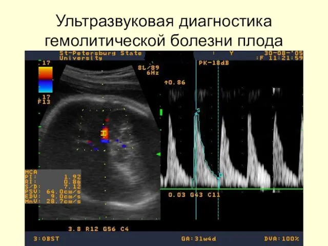 Ультразвуковая диагностика гемолитической болезни плода