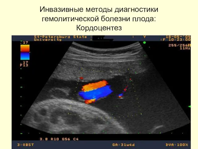 Инвазивные методы диагностики гемолитической болезни плода: Кордоцентез