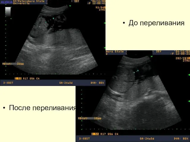 До переливания После переливания