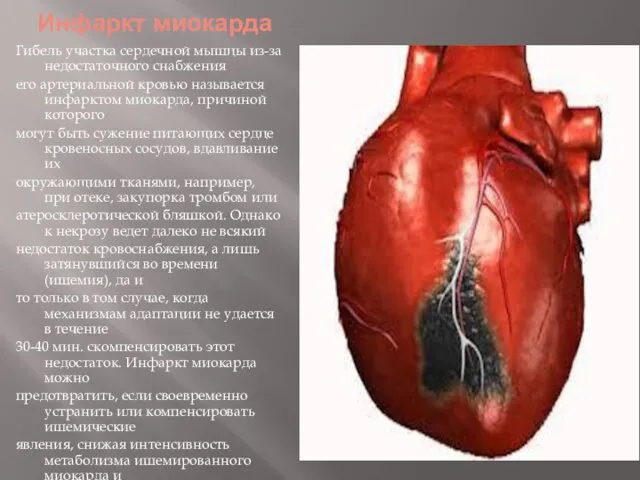 Инфаркт миокарда Гибель участка сердечной мышцы из-за недостаточного снабжения его