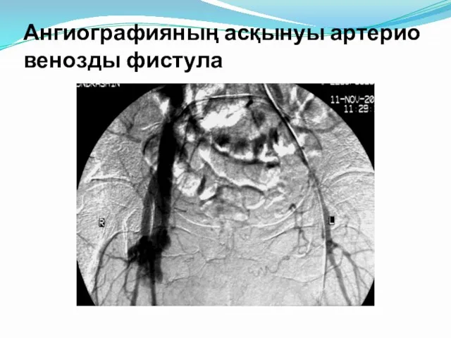 Ангиографияның асқынуы артерио венозды фистула