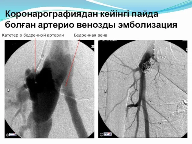 Коронарографиядан кейінгі пайда болған артерио венозды эмболизация Катетер в бедренной артерии Бедренная вена