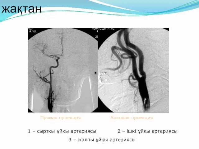 Каротидті артериография оң жақтан 1 – сыртқы ұйқы артериясы 1 3 2 1