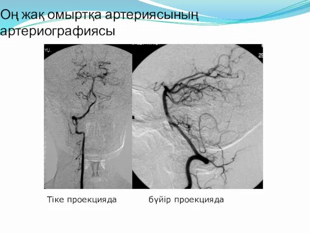 Оң жақ омыртқа артериясының артериографиясы Тіке проекцияда бүйір проекцияда