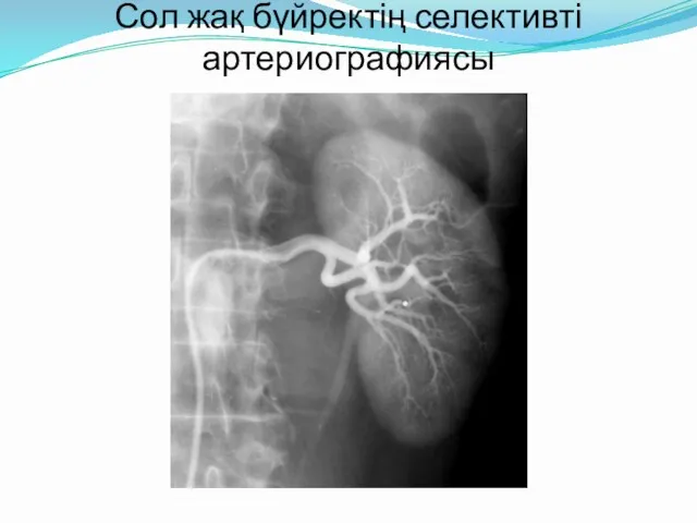 Сол жақ бүйректің селективті артериографиясы