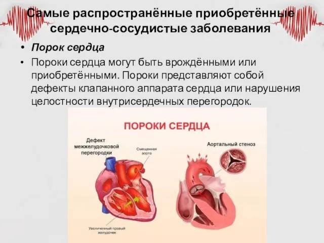 Самые распространённые приобретённые сердечно-сосудистые заболевания Порок сердца Пороки сердца могут