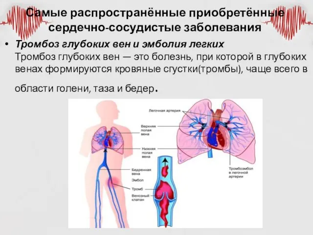 Самые распространённые приобретённые сердечно-сосудистые заболевания Тромбоз глубоких вен и эмболия