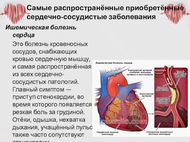 Ишемическая болезнь сердца Это болезнь кровеносных сосудов, снабжающих кровью сердечную