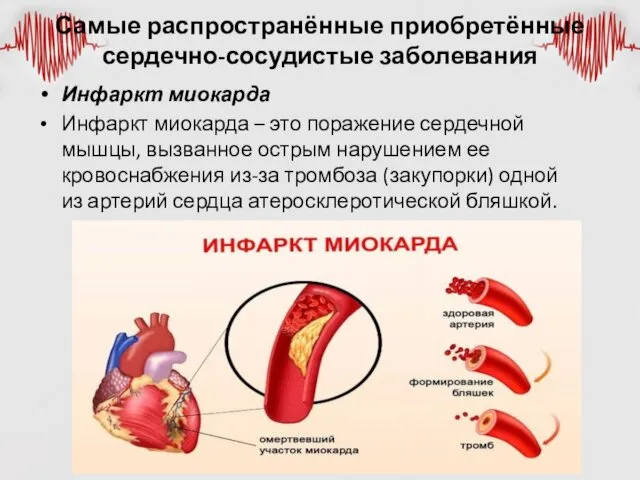 Самые распространённые приобретённые сердечно-сосудистые заболевания Инфаркт миокарда Инфаркт миокарда –