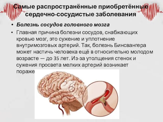 Самые распространённые приобретённые сердечно-сосудистые заболевания Болезнь сосудов головного мозга Главная