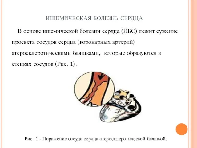 ишемическая болезнь сердца В основе ишемической болезни сердца (ИБС) лежит