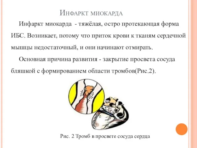 Инфаркт миокарда Инфаркт миокарда - тяжёлая, остро протекающая форма ИБС.