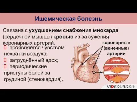 Ишемическая болезнь Связана с ухудшением снабжения миокарда (сердечной мышцы) кровью