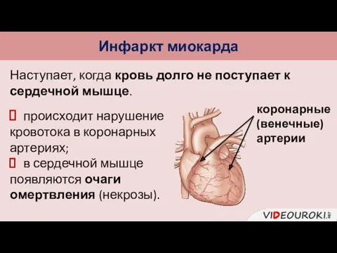 Инфаркт миокарда Наступает, когда кровь долго не поступает к сердечной