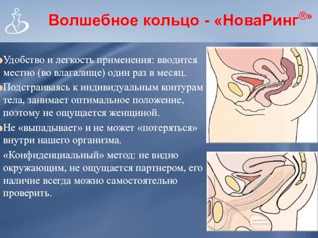 Волшебное кольцо - «НоваРинг®» Удобство и легкость применения: вводится местно