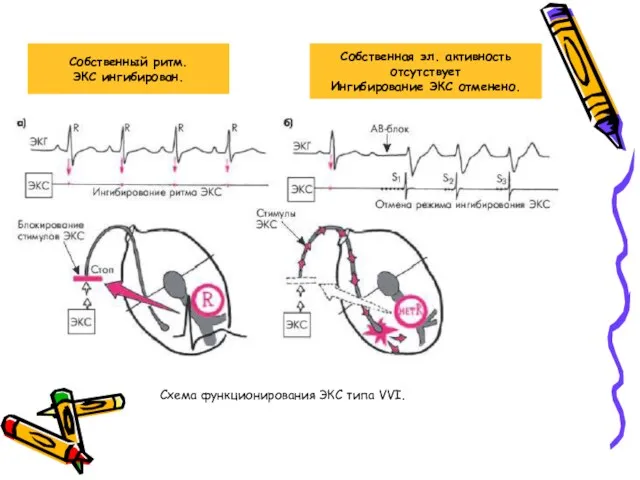 Схема функционирования ЭКС типа VVI. Собственный ритм. ЭКС ингибирован. Собственная эл. активность отсутствует Ингибирование ЭКС отменено.