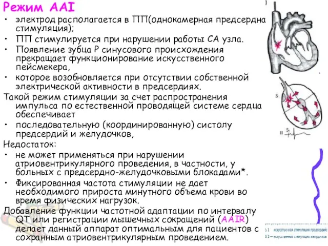 Режим AAI электрод располагается в ПП(однокамерная предсердная стимуляция); ПП стимулируется