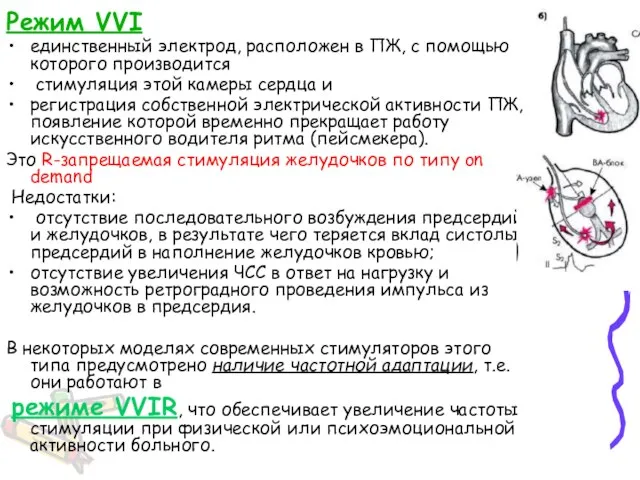 Режим VVI единственный электрод, расположен в ПЖ, с помощью которого