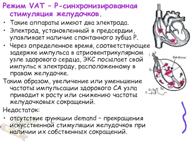 Режим VAT – Р-синхронизированная стимуляция желудочков. Такие аппараты имеют два электрода. Электрод, установленный