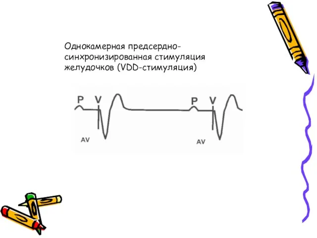 Однокамерная предсердно-синхронизированная стимуляция желудочков (VDD-стимуляция)