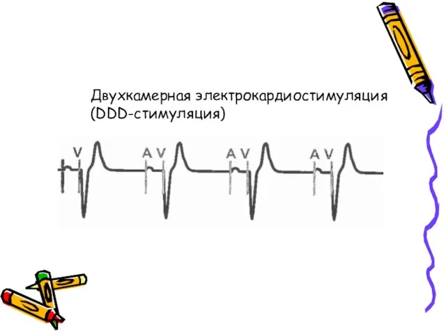 Двухкамерная электрокардиостимуляция (DDD-стимуляция)
